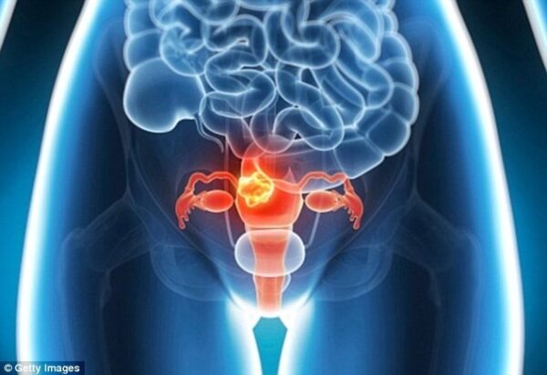 Hiểu và phòng tránh Ung thư cổ tử cung