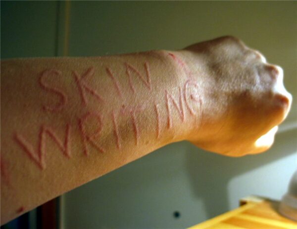 Mày đay và phù mạch